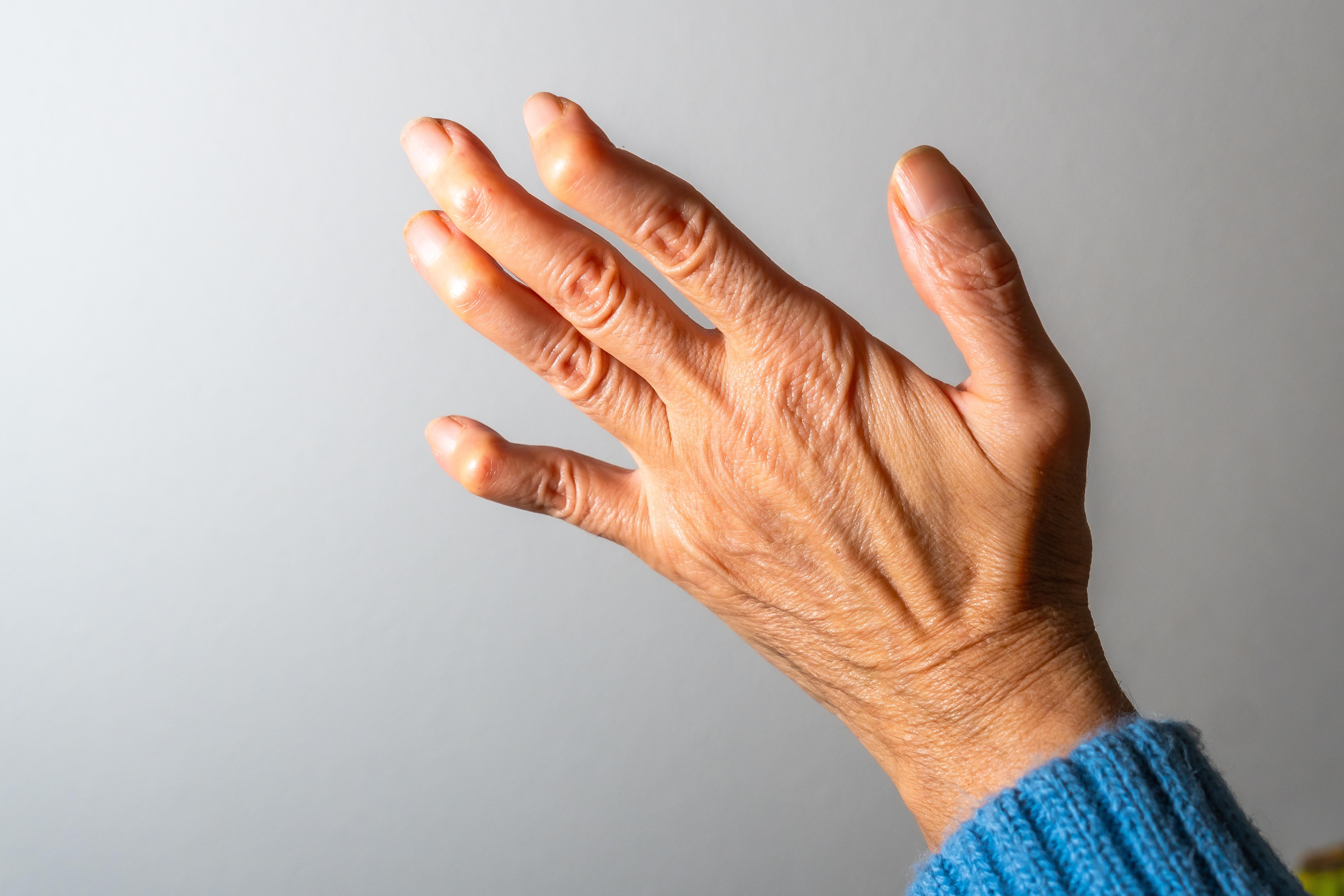 Is Arthritis A Disability? Does It Qualify For Disability Benefits